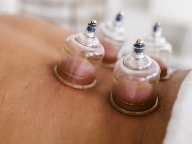 Cupping